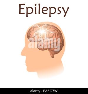 Epilepsie, Illustration. Elektrische Entladungen im Gehirn. Stockfoto