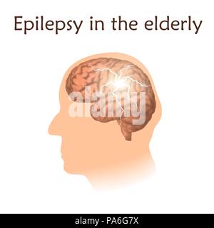 Epilepsie bei älteren Menschen, Illustration. Elektrische im Gehirn eines alten Mannes. Stockfoto