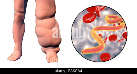 Elephantiasis. Computer Abbildung des Bein einer Person beeinträchtigt durch Elefantiasis, auch als die lymphatische Filariose bekannt, und Nahaufnahme der microfilaria im Blut der Patienten. Diese Erkrankung, die durch parasitäre Nematoden Würmer in larvale Form durch den Biss von Moskitos übertragen wurden. Stockfoto