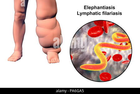 Elephantiasis. Computer Abbildung des Bein einer Person beeinträchtigt durch Elefantiasis, auch als die lymphatische Filariose bekannt, und Nahaufnahme der microfilaria im Blut der Patienten. Diese Erkrankung, die durch parasitäre Nematoden Würmer in larvale Form durch den Biss von Moskitos übertragen wurden. Stockfoto