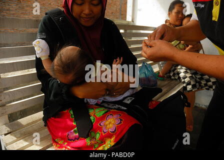 BCG-Impfung ist eine der Impfungen, die dem Baby gegeben werden. Seine Funktion ist, um zu verhindern, dass Tuberkulose (Tuberkulose) Krankheit oder was jetzt als TB bekannt. BCG ist eine Erweiterung von Bacillus Calmette-Guérin. Bereitstellung von BCG-Impfung bei Säuglingen in Indonesien ist in der Regel an Neugeborenen durchgeführt und liegt in der neuesten gegeben, bevor das Baby 3 Monate alt wird empfohlen. Für Säuglinge, die BCG-Impfung ab dem Alter von 3 Monaten gegeben werden, sollte geprüft werden, erste Tuberkulin. Die tuberkulinprobe (Mantoux Test) erfolgt durch die Injektion der Protein der TB Mikrobe (Antigen) in der oberen Ein Stockfoto