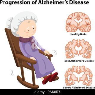 Das Fortschreiten von Alzheimer Krankheit Abbildung Stock Vektor