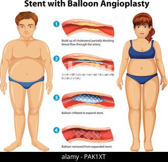 Stent mit Ballon Angioplastie Abbildung Stock Vektor