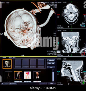 Die Magnetresonanztomographie (MRT) scan-CT Scans von menschlichen Kopf auf einem Ultraschall Computer überwachen. Stockfoto