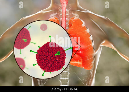 Adenoviren Anstecken der menschlichen Lunge, computer Abbildung. Adenoviren sind DNA-Viren, die am häufigsten der oberen Atemwege, Augen und Darm infizieren. Gelegentlich können Sie der unteren Atemwege Infektion (Pneumonie), insbesondere bei Kindern und immungeschwächten Patienten. Stockfoto