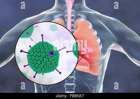 Adenoviren Anstecken der menschlichen Lunge, computer Abbildung. Adenoviren sind DNA-Viren, die am häufigsten der oberen Atemwege, Augen und Darm infizieren. Gelegentlich können Sie der unteren Atemwege Infektion (Pneumonie), insbesondere bei Kindern und immungeschwächten Patienten. Stockfoto