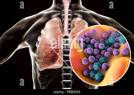 Lungenentzündung gemischter Ätiologie, konzeptionelle Darstellung. Die menschliche Lunge und Nahaufnahme von Bakterien und Viren, zwei der Erreger der Lungenentzündung. Stockfoto