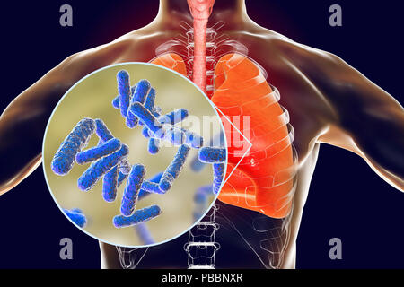 Bakterielle Pneumonie, konzeptionelle Darstellung. Die menschliche Lunge und Nahaufnahme von Bakterien, einer der Erreger der Lungenentzündung. Stockfoto