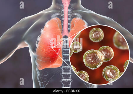 Pulmonale Blastomykose, konzeptionelle Darstellung. Blastomyces dermatitidis Pilz ist der Erreger der Krankheit Blastomykose, das eine Reihe von Präsentationen. Es betrifft vor allem die Lunge und kann eine Grippe - wie Krankheit, eine akute Krankheit ähnlich wie Lungenentzündung, einer chronischen Krankheit wie Tuberkulose oder die möglicherweise tödliche akute respiratorische Syndrom verursachen. In einigen Fällen kann es auf die Haut, Knochen oder Organe ausbreiten und Läsionen. Die Behandlung mit Antimykotika. Stockfoto