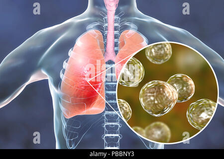 Pulmonale Blastomykose, konzeptionelle Darstellung. Blastomyces dermatitidis Pilz ist der Erreger der Krankheit Blastomykose, das eine Reihe von Präsentationen. Es betrifft vor allem die Lunge und kann eine Grippe - wie Krankheit, eine akute Krankheit ähnlich wie Lungenentzündung, einer chronischen Krankheit wie Tuberkulose oder die möglicherweise tödliche akute respiratorische Syndrom verursachen. In einigen Fällen kann es auf die Haut, Knochen oder Organe ausbreiten und Läsionen. Die Behandlung mit Antimykotika. Stockfoto