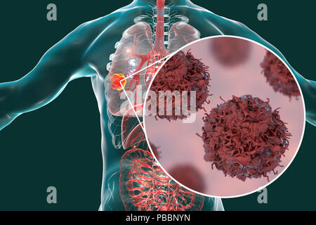 Lungenkrebs. Computer zeigt einen cancerous Tumor in der Lunge und eine Nahaufnahme der Lungenkrebszellen. Stockfoto