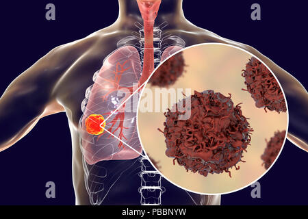 Lungenkrebs. Computer zeigt einen cancerous Tumor in der Lunge und eine Nahaufnahme der Lungenkrebszellen. Stockfoto