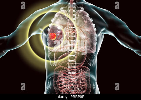 Behandlung und Vorbeugung von Lungenkrebs, konzeptionelle Computer Abbildung. Stockfoto