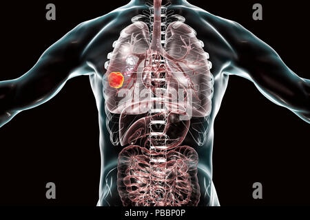 Lungenkrebs, computer Abbildung. Stockfoto
