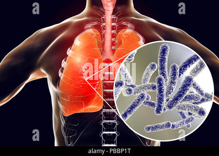 Die Legionärskrankheit, konzeptionelle Computer Abbildung. Legionella pneumophila Bakterien sind die Ursache der Legionärskrankheit. Diese Bazillen (stäbchenförmige Bakterien) sind Gram-negative. L. pneumophila wurde als pathogen nach einem mysteriösen Ausbruch der Pneumonie identifiziert 29 Todesfälle in einem amerikanischen Legion Convention 1976 verursacht. Dieses Bakterium lebte in Wassertanks, Regenduschen und Klimaanlagen gefunden. Die Krankheit verursacht tödlichen Lungenpest Lungenschäden bei älteren Menschen und ungeeignet. Stockfoto