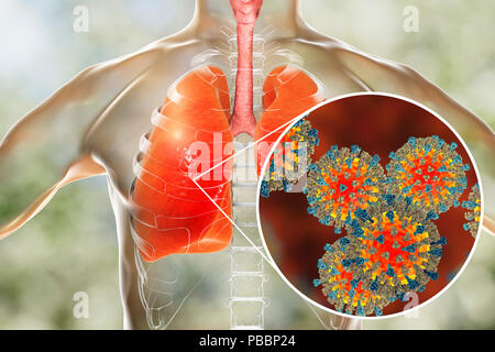 Lungenentzündung durch Masern Viren, konzeptionelle Computer Abbildung verursacht. Masern Virus aus der Gruppe der Viren Morbillivirus, besteht aus einem RNA (Ribonukleinsäure) Kern durch einen Umschlag mit oberflächenproteine Hämagglutinin und Neuraminidase und Fusion Protein, die verwendet werden, um und durchdringen eine Wirtszelle zu befestigen umgeben. Masern ist eine hoch ansteckende juckender Hautausschlag mit Fieber. Es betrifft vor allem Kinder, aber einen Angriff Normalerweise gibt lebenslange Immunität. Eine Pneumonie ist eine der häufigsten Komplikationen der Masern. Stockfoto