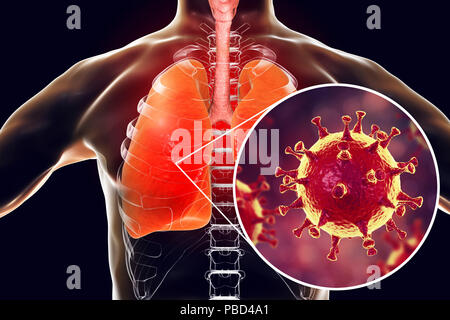 MERS virus Infektion der Lungen, konzeptionelle Darstellung. MERS (Naher Osten respiratorisches Syndrom) ist eine virale Erkrankung der Atemwege, die durch die MERS-assoziierten Coronavirus (MERS-CoV). Früher als neuartiges Coronavirus bekannt, MERS wurde zuerst in Saudi-Arabien im Jahr 2012 identifiziert. Die meisten Leute angesteckt mit MERS entwickeln schwere akute respiratorische Erkrankungen mit Symptomen wie Fieber, Husten und Kurzatmigkeit. Stockfoto