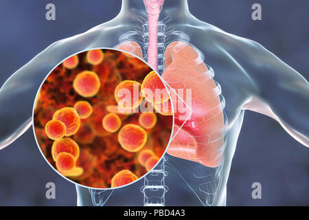 Lungenentzündung durch Mycoplasma pneumoniae Bakterien, konzeptionelle Computer Abbildung verursacht. Stockfoto