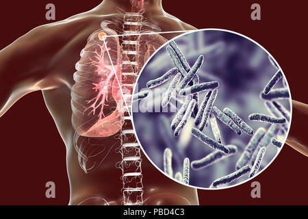 Sekundäre Tuberkulose Infektionen und Nahaufnahme von Mycobacterium Tuberkulose, Bakterien, Erreger der Tuberkulose. Computer Abbildung kleine - große Feste noduläre Masse im oberen Lungenlappen rechten Lungenflügel in der Nähe der Lunge Apex entfernt. Stockfoto