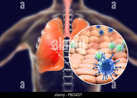 Virale Lungenentzündung, konzeptionelle Darstellung. Die menschliche Lunge und Nahaufnahme von Viren, die Erreger der Lungenentzündung. Pneumonie kann durch viele Arten von Viren, einschließlich Grippe, MERS, SARS, Adenoviren und andere verursacht werden. Stockfoto