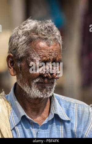 Belathur, Karnataka, Indien - November 1, 2013: Nahaufnahme von Mann mit neurofibromatose hat Gesicht mit Gruppe von dunkelbraun Tumoren auf seiner Nase verformt. Bl Stockfoto