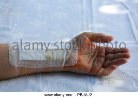 Einen Verband an das Handgelenk an eine Person, die einfach für ein gebrochenes Handgelenk durchgeführt wurde. Stockfoto