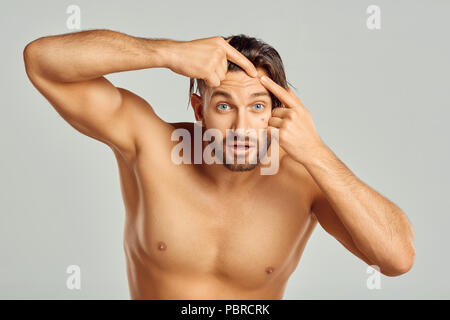 Junger Mann Mit Akne Und Pickel Auf Der Haut Mit Braunen Flecken Akne Im Gesicht Von Hormon Oder Schmutz Und Bakterien Die Narben Und Falten Und Akne Stockfotografie Alamy