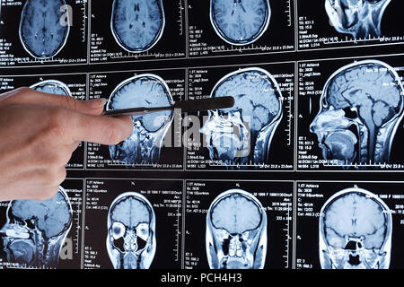 Mrt-Scan des Gehirns. MRI-Scan. Stockfoto