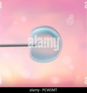 ICSI-in-vitro-Fertilisation. Abbildung einer menschlichen Eizelle (Ovum, Mitte) gedüngt wird mit einer Samenzelle (Spermium) durch die intrazytoplasmatische Spermieninjektion (ICSI). Stockfoto