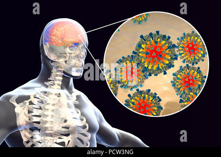 Enzephalitis durch Masern Viren, computer Abbildung verursacht. Dieses Virus aus der Gruppe der Viren Morbillivirus, besteht aus einem RNA (Ribonukleinsäure) Kern durch einen Umschlag mit oberflächenproteine Hämagglutinin und Neuraminidase und Fusion Protein, die verwendet werden, um und durchdringen eine Wirtszelle zu befestigen umgeben. Masern ist eine hoch ansteckende juckender Hautausschlag mit Fieber. Es betrifft vor allem Kinder und einen Angriff Normalerweise gibt lebenslange Immunität. Enzephalitis ist eine der Komplikationen einer Maserninfektion. Stockfoto