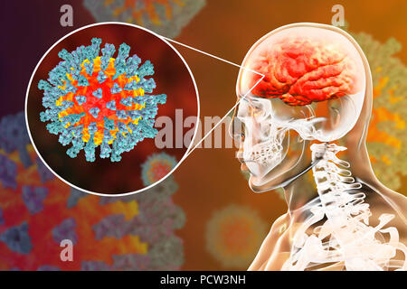 Enzephalitis durch Masern Viren, computer Abbildung verursacht. Dieses Virus aus der Gruppe der Viren Morbillivirus, besteht aus einem RNA (Ribonukleinsäure) Kern durch einen Umschlag mit oberflächenproteine Hämagglutinin und Neuraminidase und Fusion Protein, die verwendet werden, um und durchdringen eine Wirtszelle zu befestigen umgeben. Masern ist eine hoch ansteckende juckender Hautausschlag mit Fieber. Es betrifft vor allem Kinder und einen Angriff Normalerweise gibt lebenslange Immunität. Enzephalitis ist eine der Komplikationen einer Maserninfektion. Stockfoto