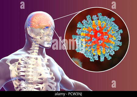 Enzephalitis durch Masern Viren, computer Abbildung verursacht. Dieses Virus aus der Gruppe der Viren Morbillivirus, besteht aus einem RNA (Ribonukleinsäure) Kern durch einen Umschlag mit oberflächenproteine Hämagglutinin und Neuraminidase und Fusion Protein, die verwendet werden, um und durchdringen eine Wirtszelle zu befestigen umgeben. Masern ist eine hoch ansteckende juckender Hautausschlag mit Fieber. Es betrifft vor allem Kinder und einen Angriff Normalerweise gibt lebenslange Immunität. Enzephalitis ist eine der Komplikationen einer Maserninfektion. Stockfoto