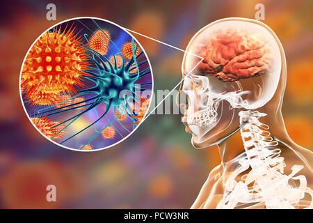 Virale Enzephalitis. Konzeptionelle Abbildung: Gehirn mit Anzeichen von Enzephalitis innerhalb der menschlichen Körper und Nahaufnahme von Viren. Stockfoto