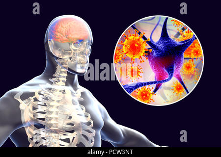 Virale Enzephalitis. Konzeptionelle Abbildung: Gehirn mit Anzeichen von Enzephalitis innerhalb der menschlichen Körper und Nahaufnahme von Viren. Stockfoto