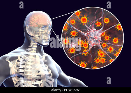 Virale Enzephalitis. Konzeptionelle Abbildung: Gehirn mit Anzeichen von Enzephalitis innerhalb der menschlichen Körper und Nahaufnahme von Viren. Stockfoto