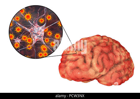 Virale Enzephalitis. Konzeptionelle Abbildung: Gehirn mit Anzeichen von Enzephalitis innerhalb der menschlichen Körper und Nahaufnahme von Viren. Stockfoto