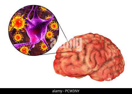 Virale Enzephalitis. Konzeptionelle Abbildung: Gehirn mit Anzeichen von Enzephalitis innerhalb der menschlichen Körper und Nahaufnahme von Viren. Stockfoto