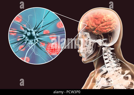 Virale Enzephalitis. Konzeptionelle Abbildung: Gehirn mit Anzeichen von Enzephalitis innerhalb der menschlichen Körper und Nahaufnahme von Viren. Stockfoto