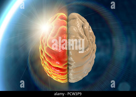 Migräne, konzeptionelle Computer Abbildung. Stockfoto