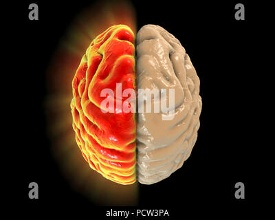 Migräne, konzeptionelle Computer Abbildung. Stockfoto