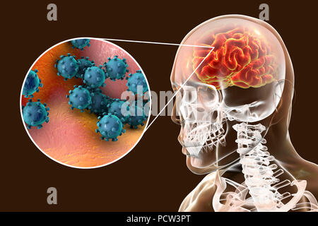 Virale Enzephalitis. Konzeptionelle Abbildung: Gehirn mit Anzeichen von Enzephalitis innerhalb der menschlichen Körper und Nahaufnahme von Viren. Stockfoto