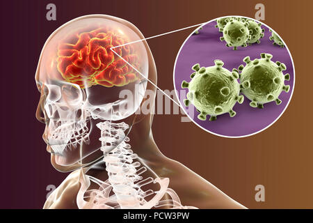 Virale Enzephalitis. Konzeptionelle Abbildung: Gehirn mit Anzeichen von Enzephalitis innerhalb der menschlichen Körper und Nahaufnahme von Viren. Stockfoto