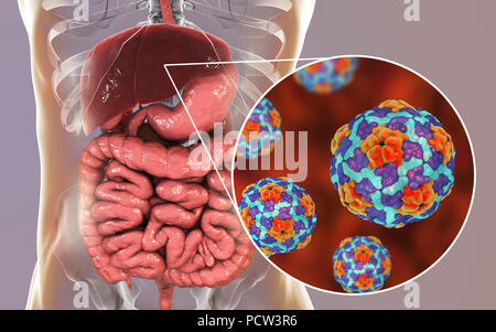 Hepatitis-A-Infektion. Computer Abbildung Leber angezeigt und Nahaufnahme der Hepatitis-A-Viren. Stockfoto
