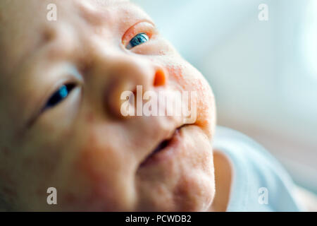 Neugeborenes Baby Junge Gesicht mit vielen roten Pickel von atopischer Dermatitis verursacht Stockfoto