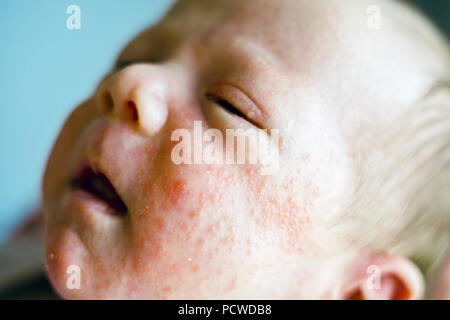 Neugeborenes Baby Junge Gesicht mit vielen roten Pickel von atopischer Dermatitis verursacht Stockfoto