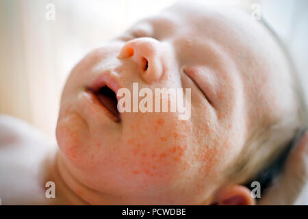 Neugeborenes Baby Junge Gesicht mit vielen roten Pickel von atopischer Dermatitis verursacht Stockfoto