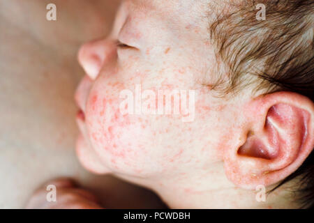 Neugeborenes Baby Junge Gesicht mit vielen roten Pickel von atopischer Dermatitis verursacht Stockfoto