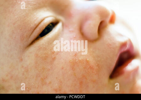 Neugeborenes Baby Junge Gesicht mit vielen Pickel von atopischer Dermatitis verursacht Stockfoto