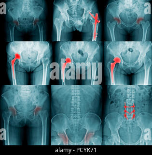 X-ray Image, Sammlung Hüftgelenk Stockfoto