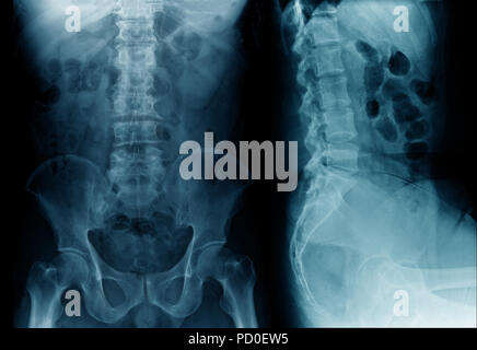 X-ray thoraco-LWS AP/Lat Stockfoto